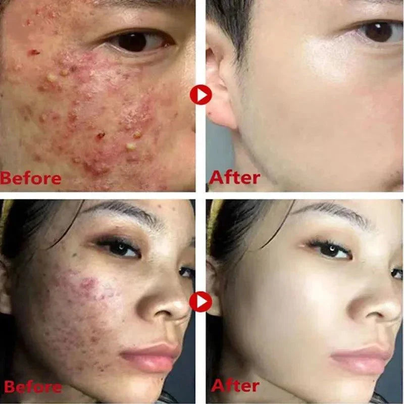 Green Tea Blackhead Removal Mask: Clear Skin Awaits You!